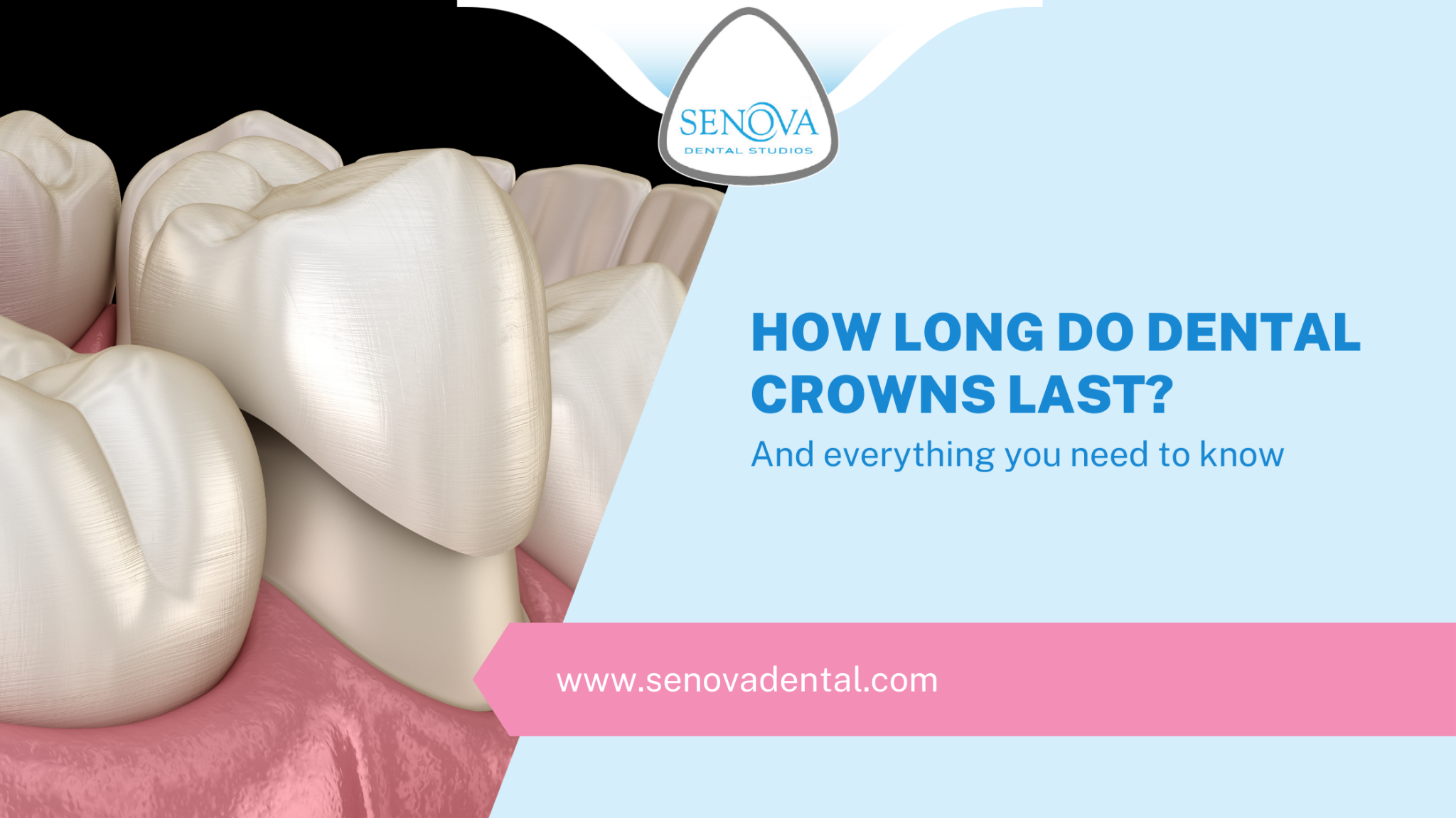 How Long Do Dental Crowns Last? Senova Blog