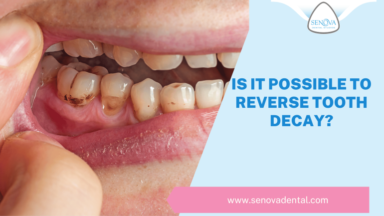 Is It Possible To Reverse Tooth Decay?