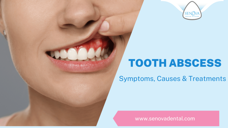 Tooth Abscess: Symptoms, Causes & Treatments